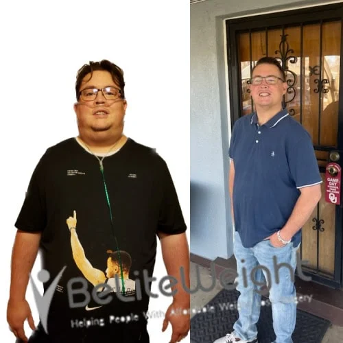 Weight Loss Surgery Gastric Sleeve before and after